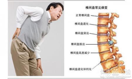 腰间盘疾病最新研究概述与疾病概述解析