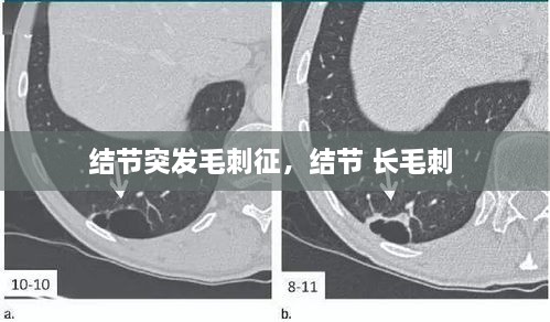 结节突发毛刺征，结节 长毛刺 