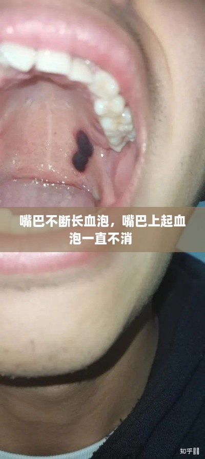 嘴巴不断长血泡，嘴巴上起血泡一直不消 