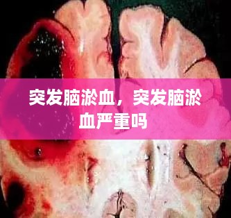 突发脑淤血，突发脑淤血严重吗 